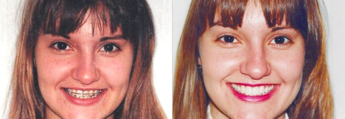 Soft Touch Dentist Before and after