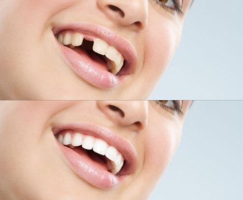 Dental Implants Newton MA