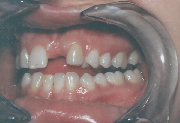 crowns bridges before case 2
