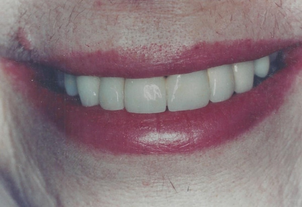fullmouthreconstruction after case 2