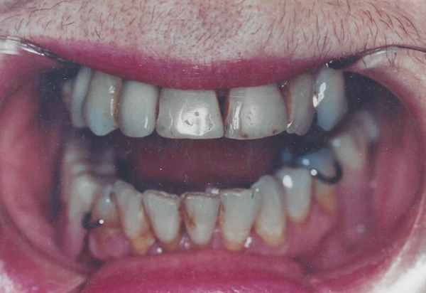fullmouthreconstruction before case 2