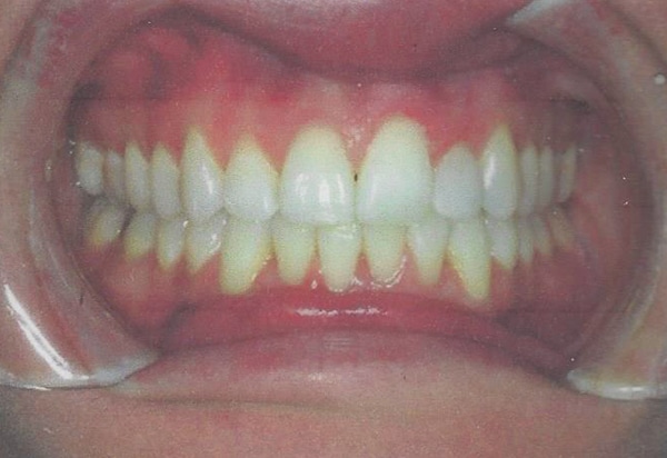 invisalign after case 1