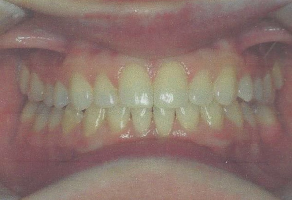invisalign after case 2