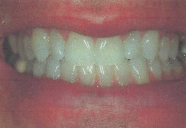 invisalign after case 3