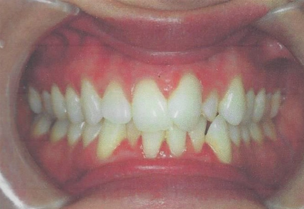 invisalign before case 1