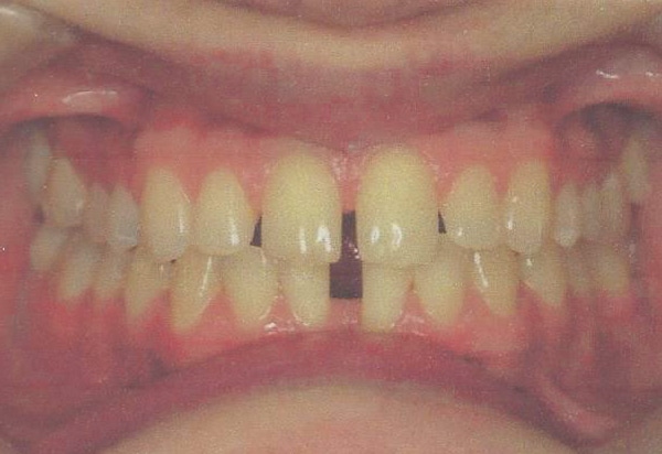 invisalign before case 2