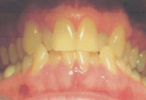 invisalign before case 3