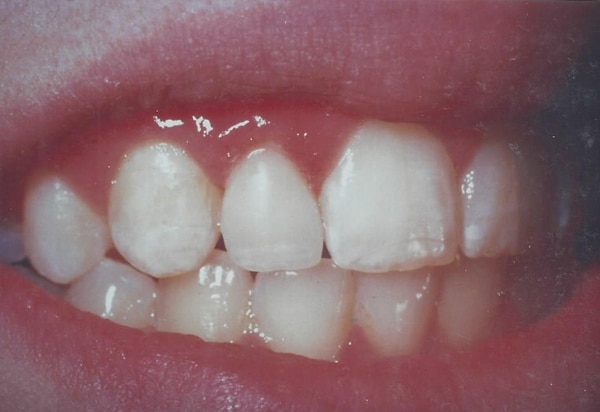 lateral veneer after case 1