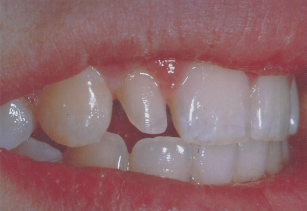 lateral veneer before case 1