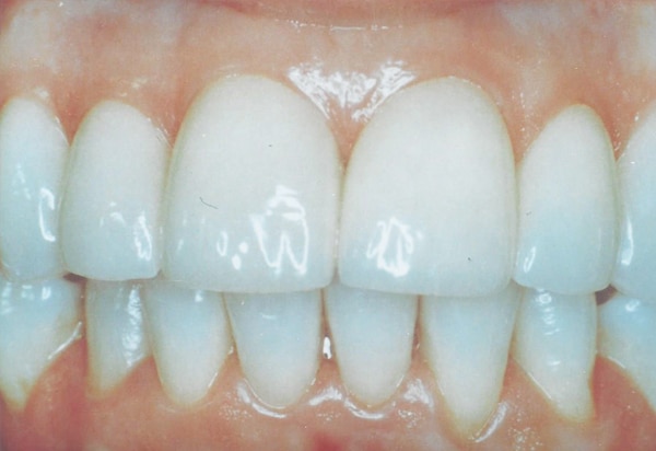 porcelin veneer after case 1