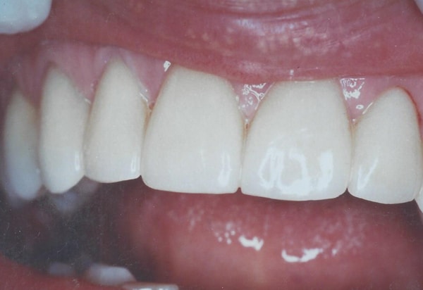 porcelin veneer after case 2