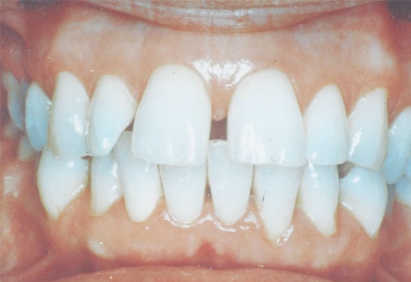 porcelin veneer before case 1