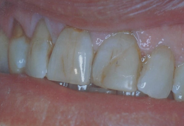 porcelin veneer before case 2