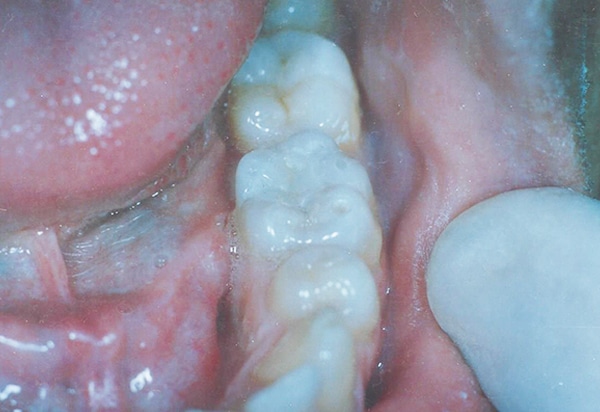 white filling after case 1