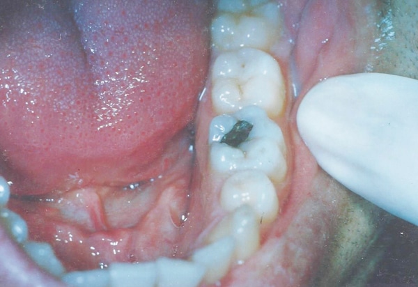 white filling before case 1